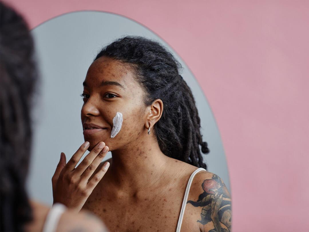 A young black woman with visible acne is seen applying a retinol-based cream to her cheek in front of a mirror, illustrating a dermatologist-recommended skincare practice for acne Desktop