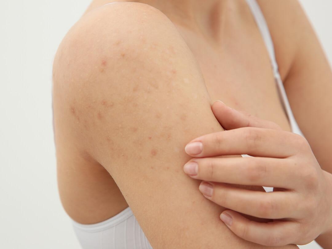 Woman scratching her shoulder with rash on white background Desktop